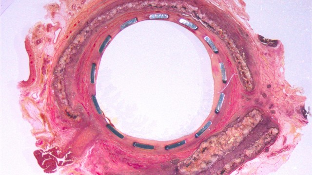 Einbettung Aorta Stent – Technovit